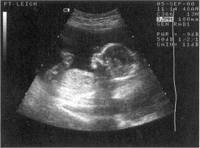 lottie twenty week scan